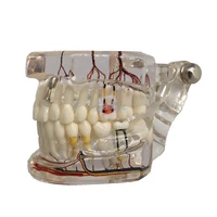 new transparentdental teaching teeth model implant with nerve lines pathological repair teaching demonstration teeth model tool