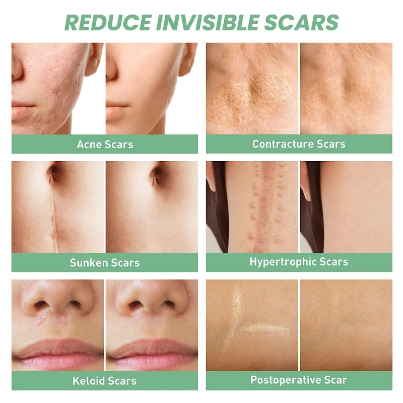 Mebak Прозрачный Силиконовый Лист Для Шрамов Безболезненная Ремонтная Лента