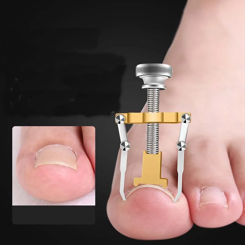

Straightening Clip Ingrown Toenail Corrector Pedicure Foot Nail Care Tool Painless Stainless Steel Pedicure Treatment Correction