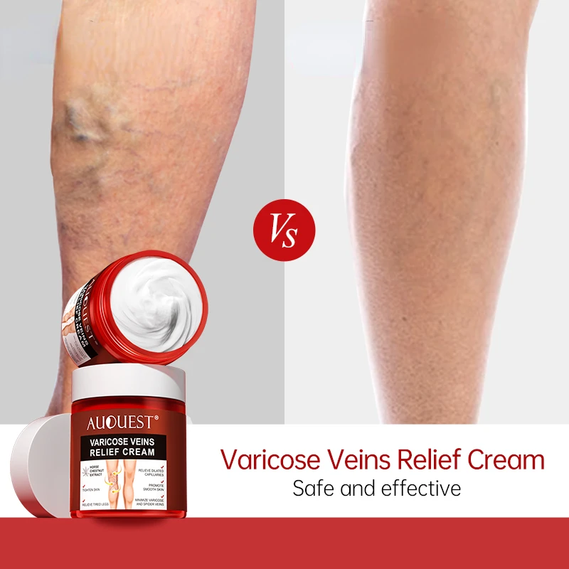 Herbal Varicose Veins Cream Treatment Vasculitis Phlebitis Spider Pain Relief Ointment Removal Remedy Cream free shipping 1pcs