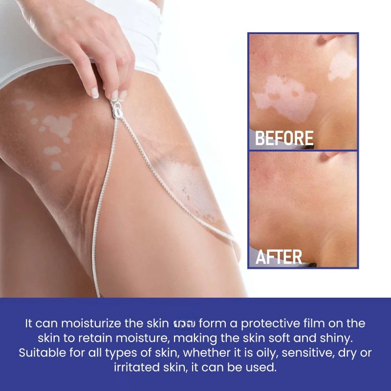 Сыворотка для лечения Vitiligo лампа роста пигмента Ringworm Tinea удаление пота и белых