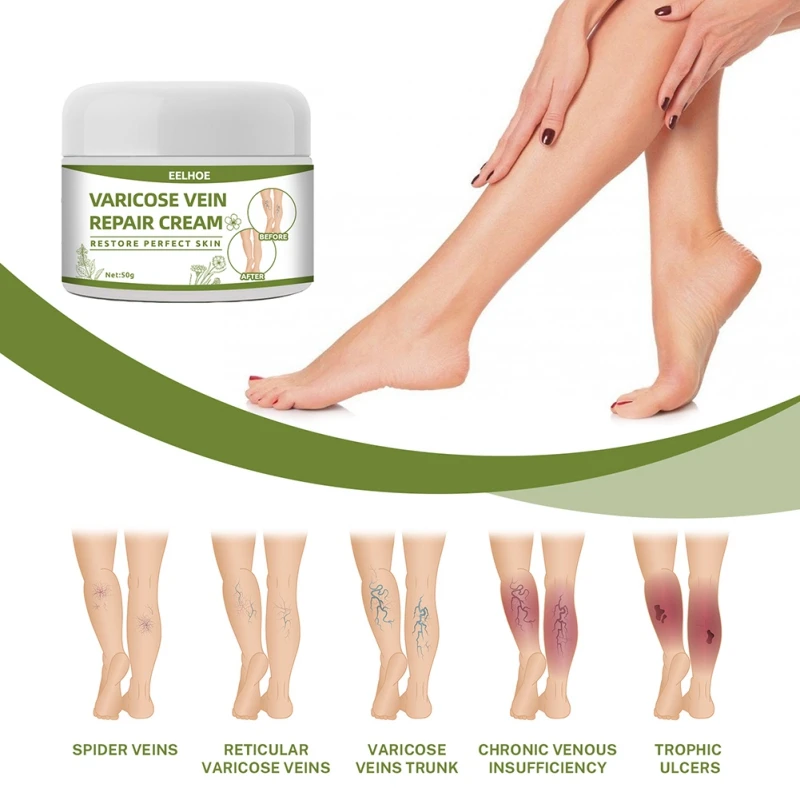 

Thigh Spider Relief Removal Vasculitis Ointment Plaster Phlebitis Swelling 50g New Varicose Vein Treatment Cream