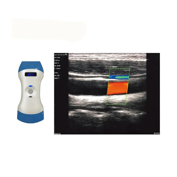 

Newest Mini Wifi 128 Elements Portable Double Head Color Doppler Wifi Ultrasound Three Probe Scanner