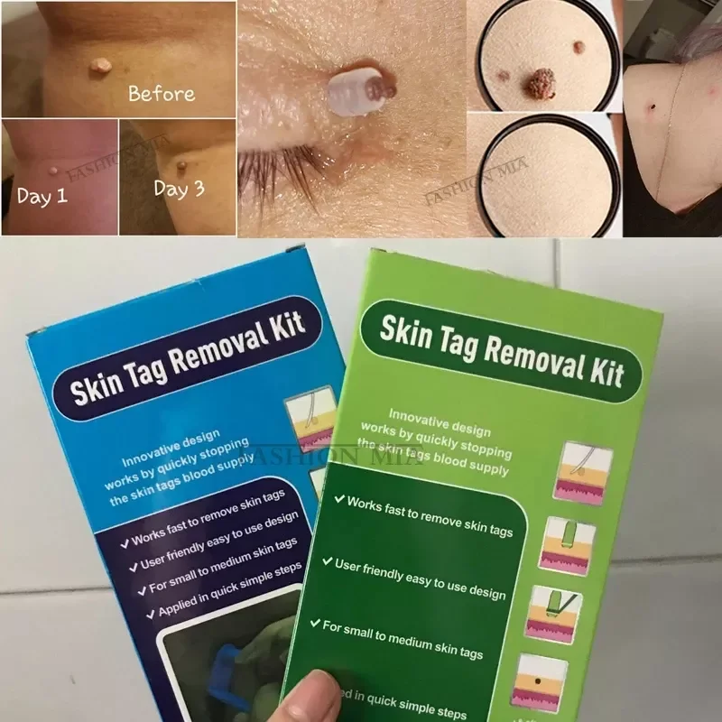 

Tag Removal Kit Papilloma Removal Skin Cleansing Kit 4-6mm Tag Treatment For Removes Berrugas In Skin Wart Mole Remover