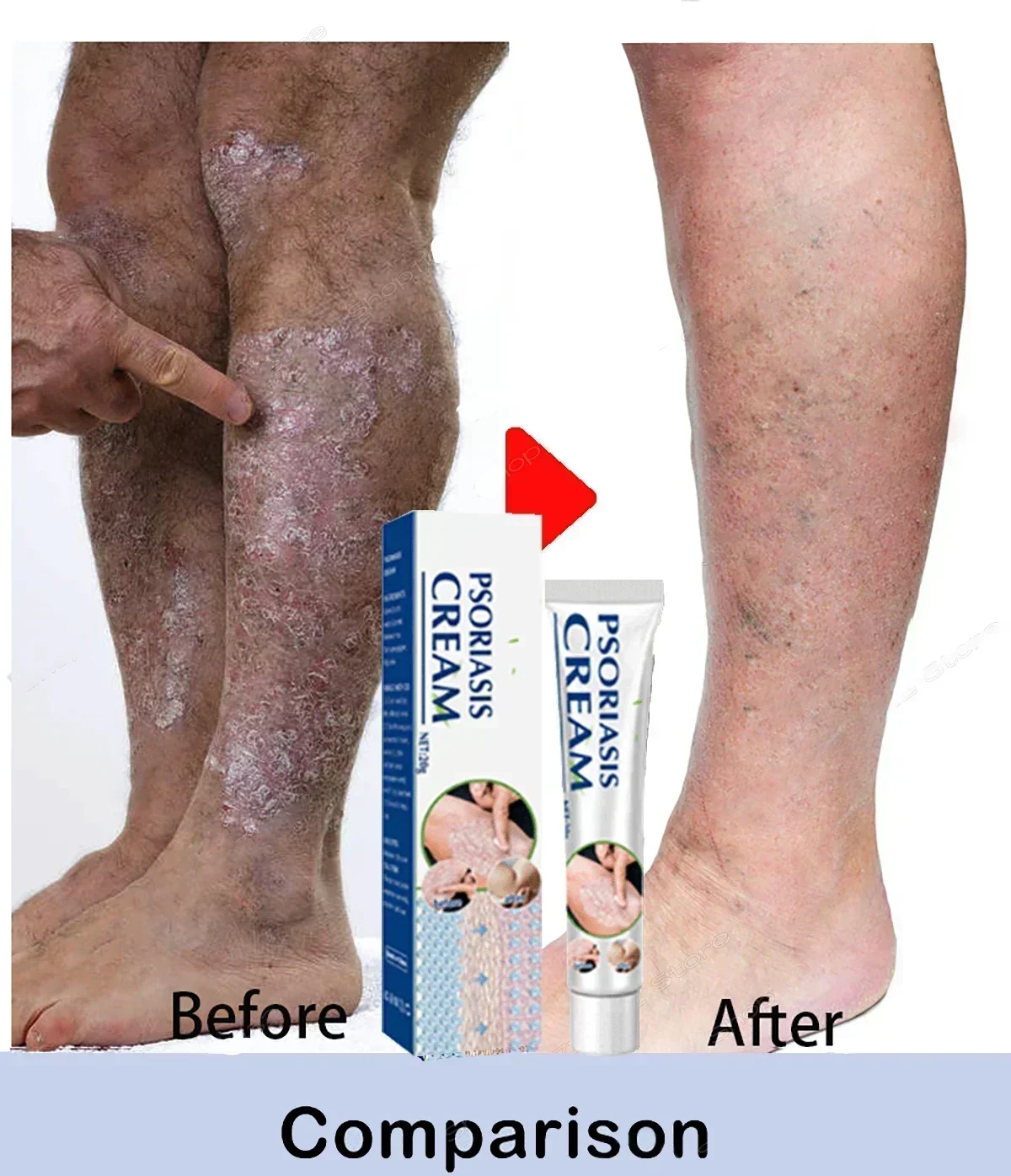 Лучший продукт против дерматита при псориазе и экземе: натуральный растительный