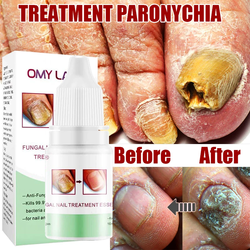 

Fungal Nail Treatment Serum Foot Nail Fungus Removal Repair Gel Anti Infection Paronychia Onychomycosis Foot Nails Care Essence