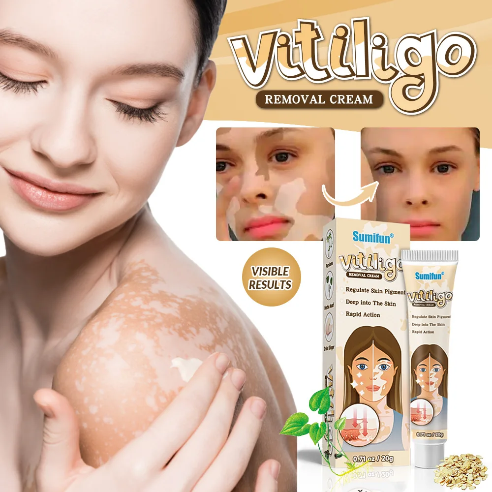 Natural Herbs White Vitiligo Treatment Cream Mushroom Skin Brown Spots Pigmentation Removal Whiten Cream Face Body Moisturizing