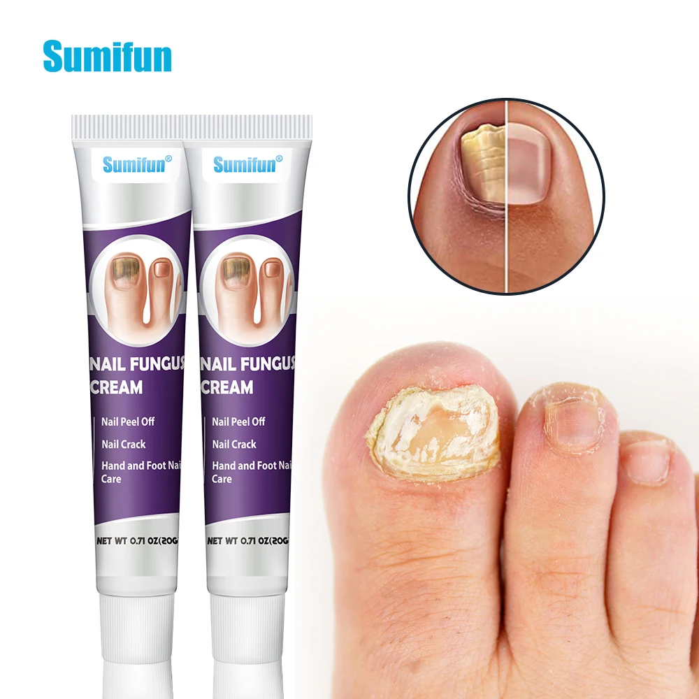 1 шт. 20 г Sumifun крем-грибок для ногтей лечение онихомикоси антиинфекционная мазь