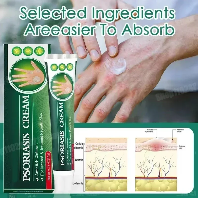 Antibacterial Cream Psoriasis Anti-itch Relief Eczema Skin Rash Urticaria Desquamation Healing
