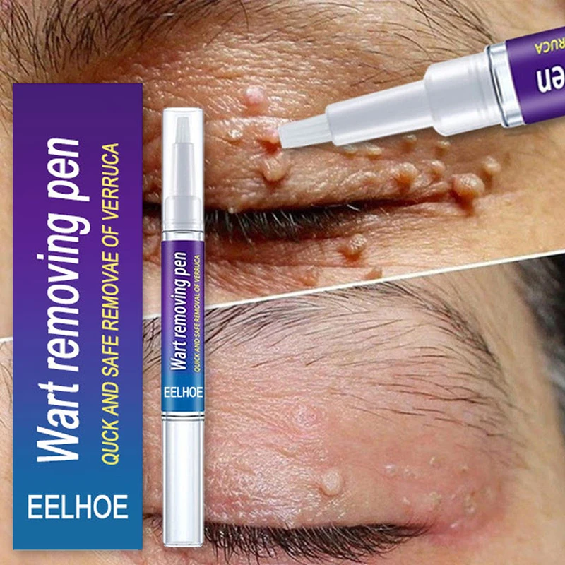 

2PCS Wart Treatment Cream Skin Tag Remover Herbal Extract Corn Plaster Warts Ointment Warts Remover Liquid Antibacterial