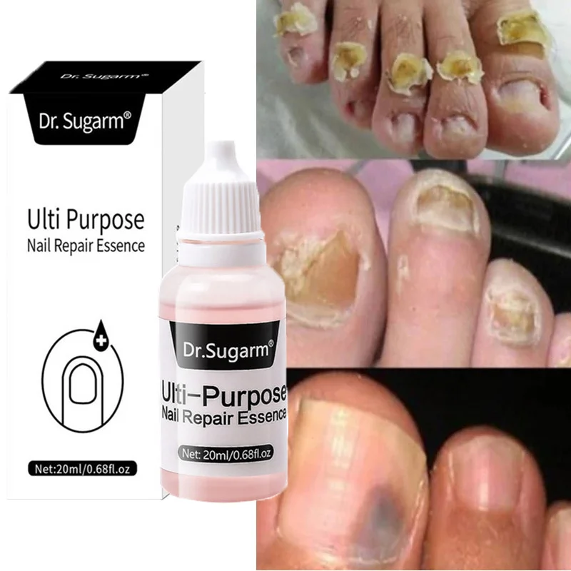 

Nail Fungal Treatment Essence Onychomycosis Paronychia Anti Infection Toe Fungus Hand Foot Remove Repair Serum Feet Care Product