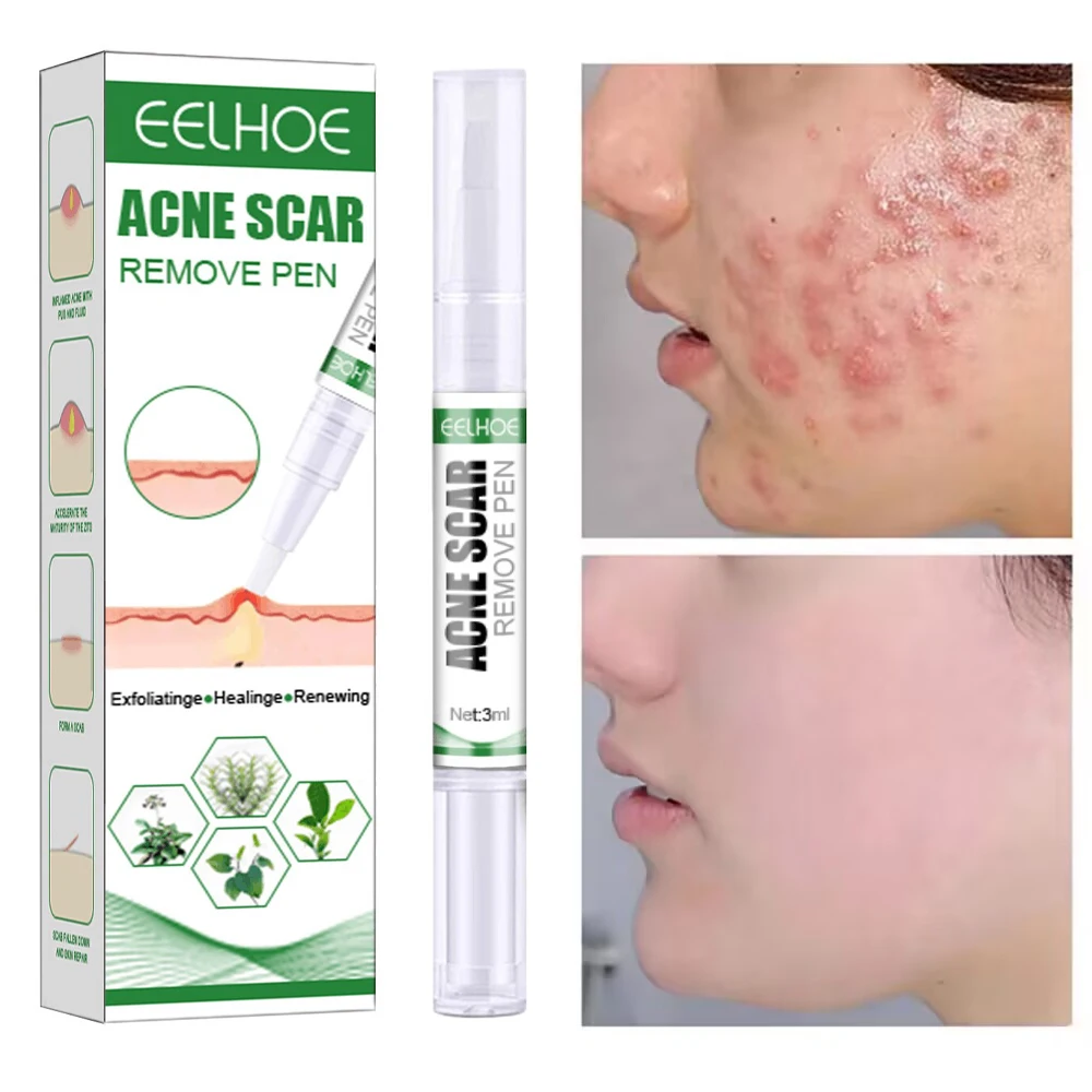 

Herbal Acne Removal Serum Pen Anti Acne Scar Treat Gel Shrink Pores Oil Control Moisturizing Repair Whitening Skin Care Products