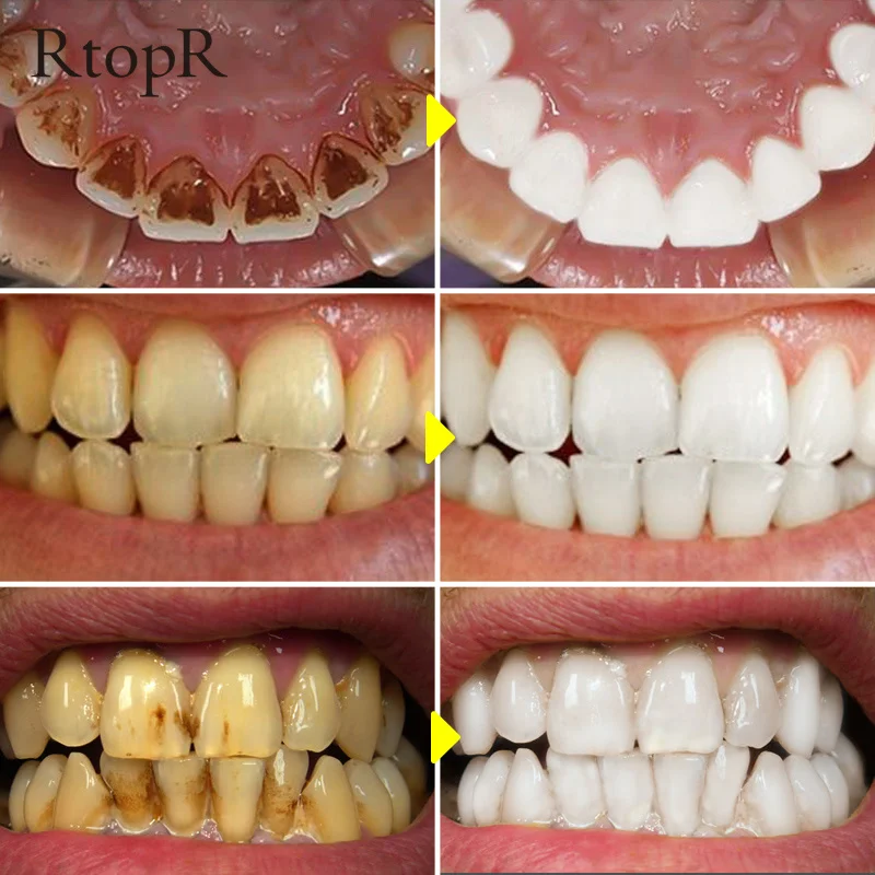 

RtopR Teeth Whitening Essence Remove Plaque Stains Oral Hygiene Bleaching Products Cleansing Fresh Breath Dentistry Care Tools
