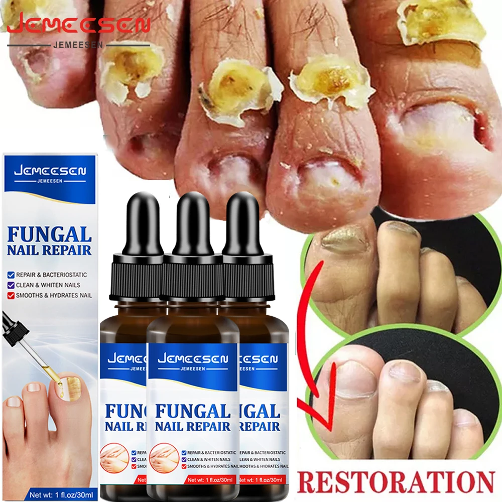 

Jemeesen Nail Fungal Treatment Serum Onychomycosis Paronychia Anti Infection Toe Fungus Hand Foot Removal Repair Gel Care Health