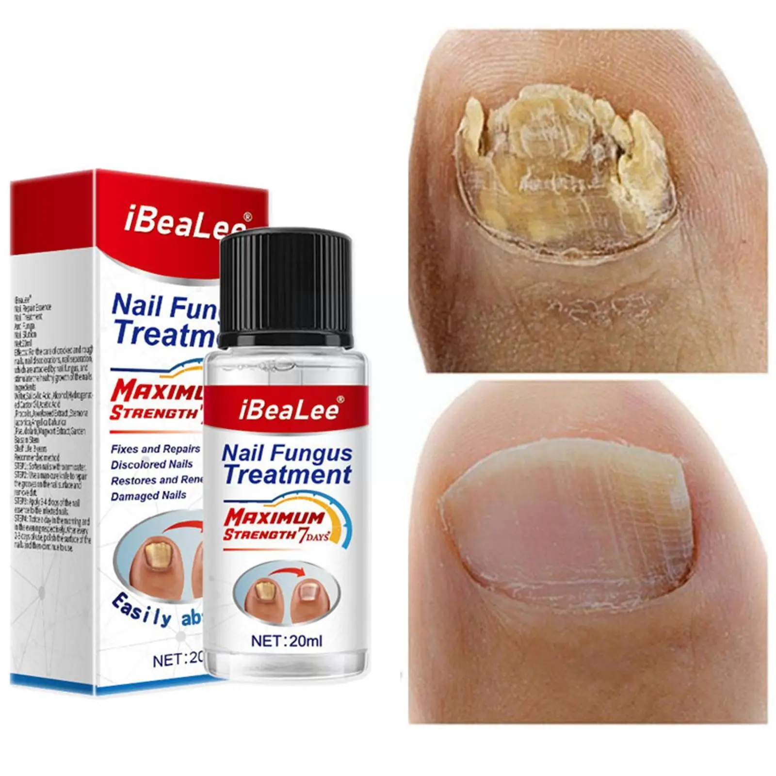 

20ML Nail Fungus Treatment Essence Serum Care Oil Hand and Care Nails Foot Repair fungal Removal Gel Anti-infective O3R0