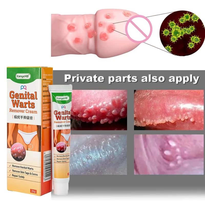 

Средство для удаления бородавок и бородавок, 20 г