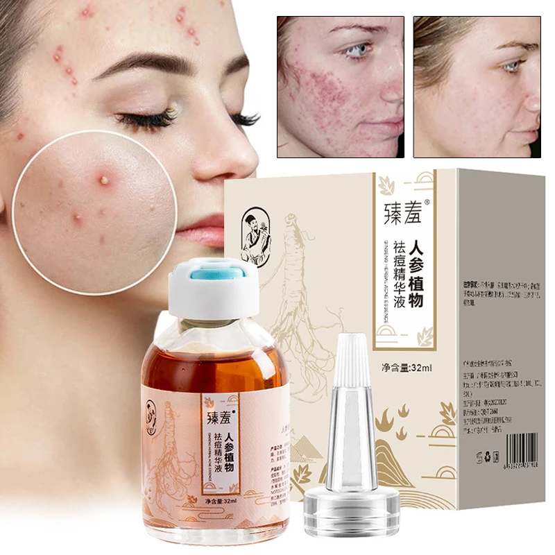 

Acne Serum Ginseng Fade Acne Spots Anti Inflammation Whitening Oil Control Moisturizer Repair Mild Not Irritating Skin Care 32ml