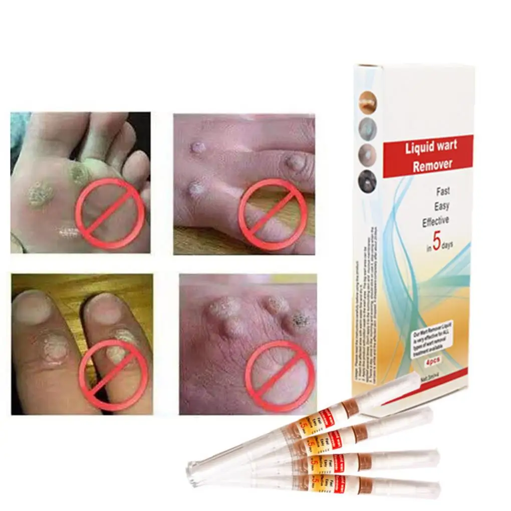 

4 шт., жидкая ручка для удаления бородавок, 3 мл