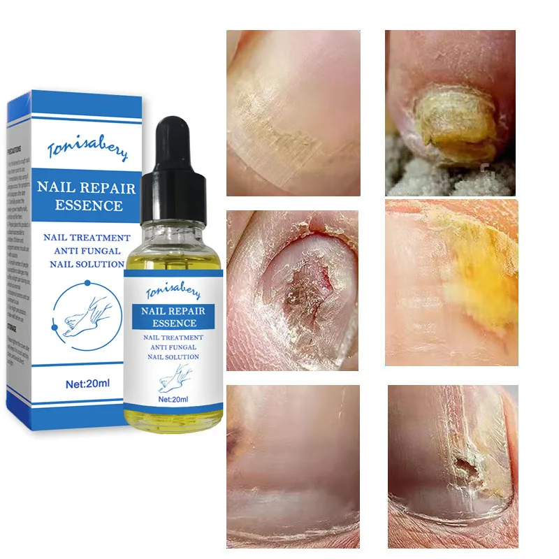 

Nail Fungal Treatment Feet Care Essence Anti Infection Paronychia Onychomycosis Nail Foot Toe Nail Fungus Removal Gel Products