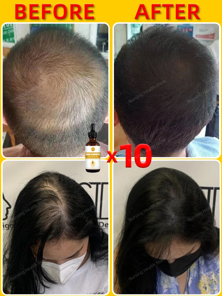 Sólo se necesitan 7 días para reparar la calvicie. El aceite esencial el crecimiento del cabello puede eficazmente