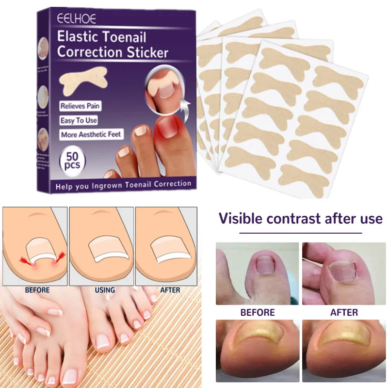 

1 Box of Elastic Toenail Correction Stick Nail Groove Positive Nail Buckle Corrector Pull Stick Nail Repair