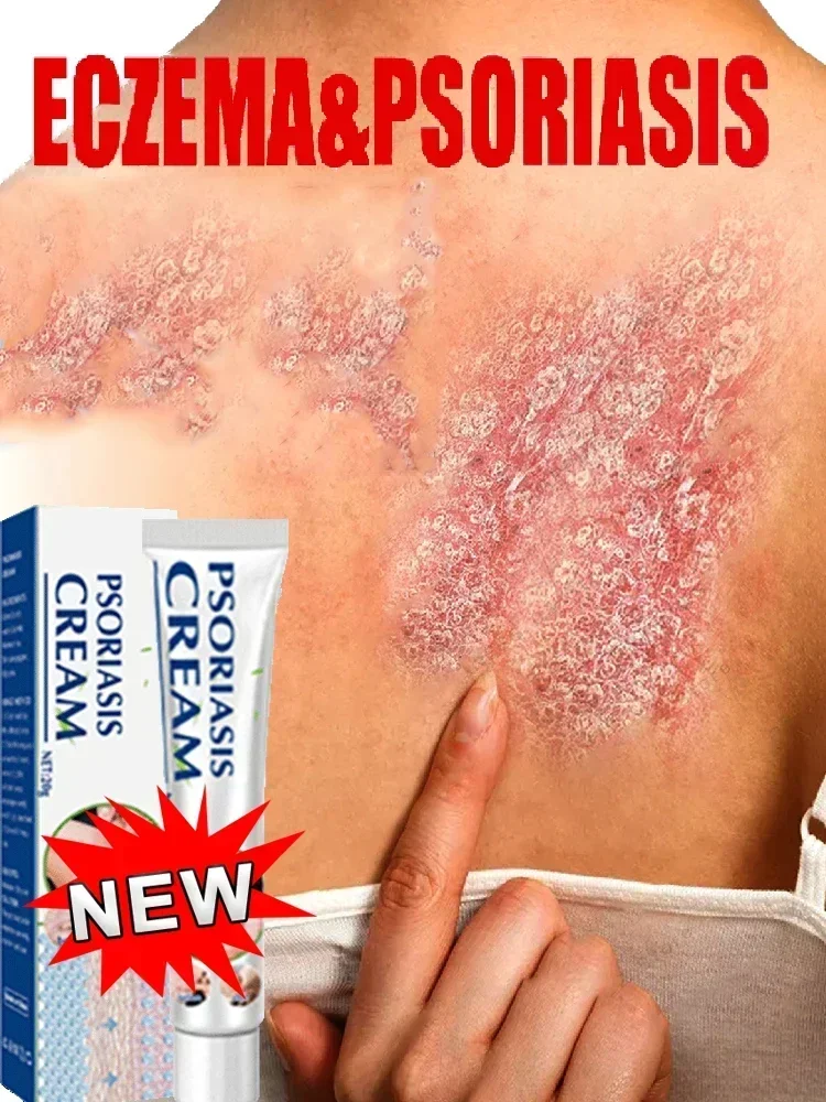 Искусственная мазь при псориазе кожи головы крем от зуда для рук и ног