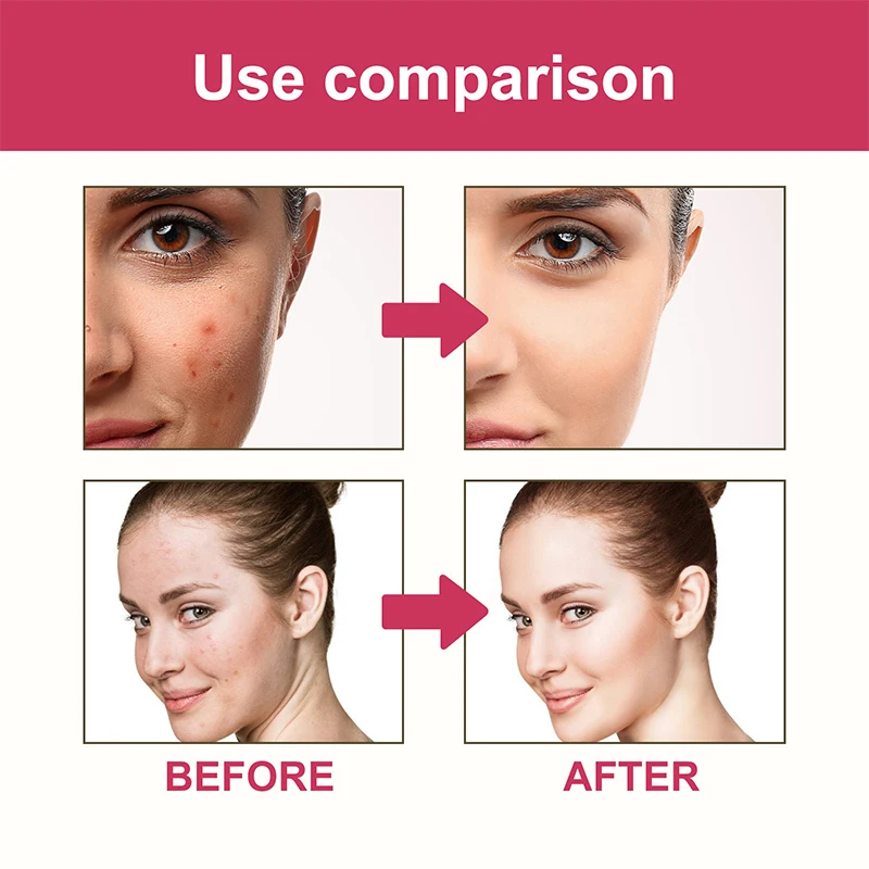 144 шт./коробка цветные наклейки для удаления акне