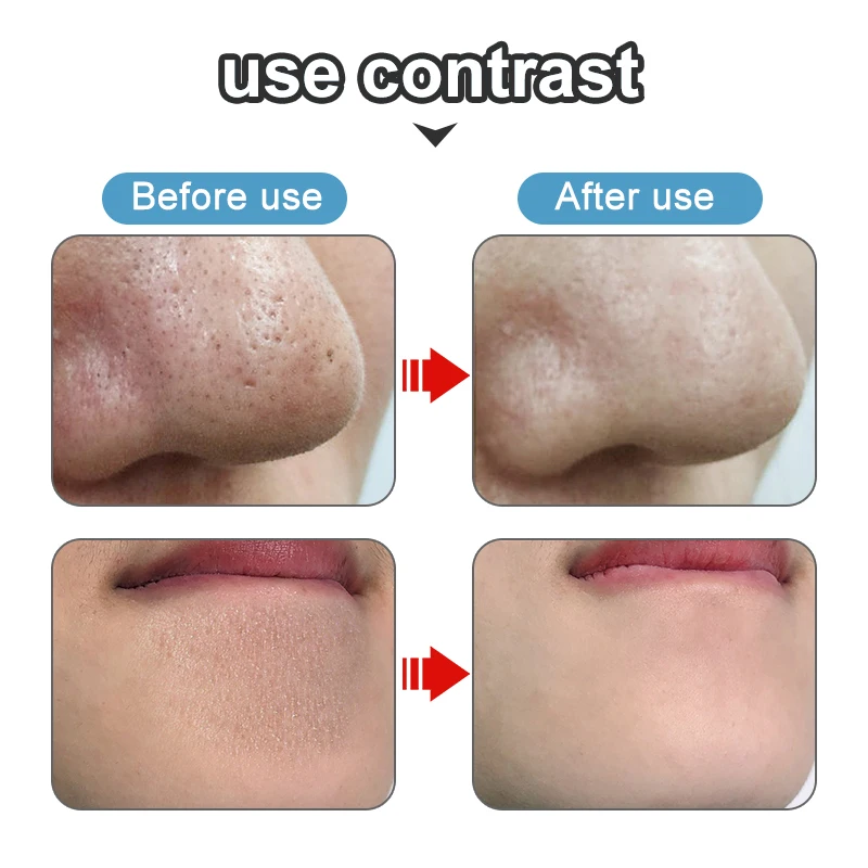 Blackhead Acne Remover Tool Stainless Steel Needles Comedone Black Spot Pimple Treatment For Face Skin Care Facial Pore Cleaner |