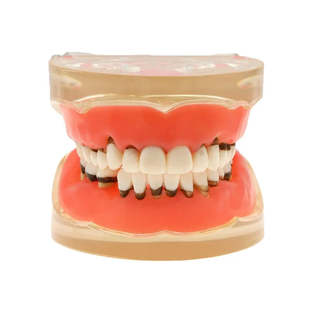 

Dental Model Adult Pathological Periodontal Disease Study Teach Teeth M4017