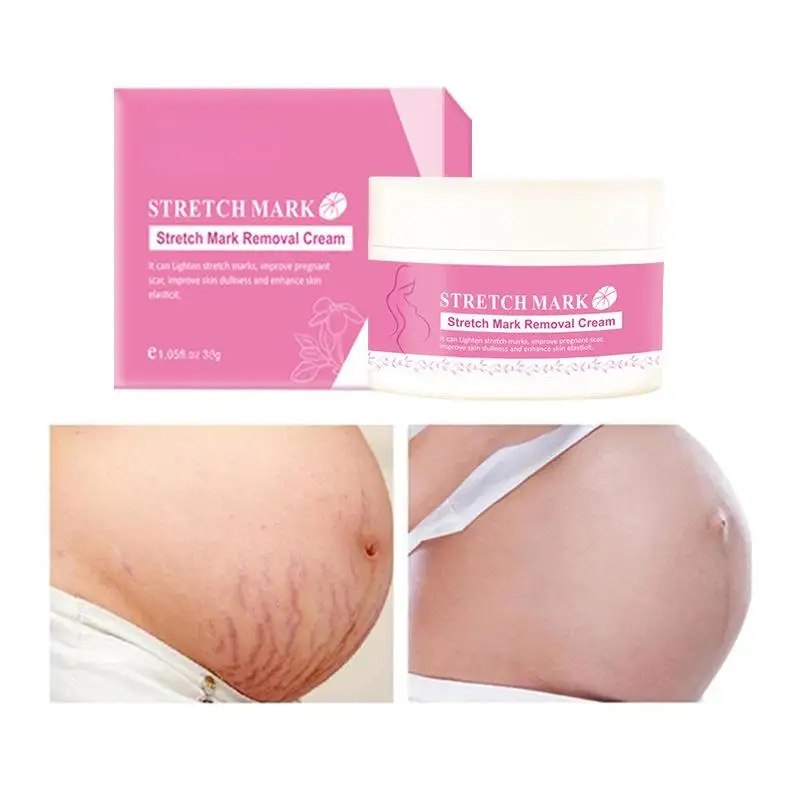 

Removal Acne Scar Cream Fat Scar Striae Gravidarum Treatment