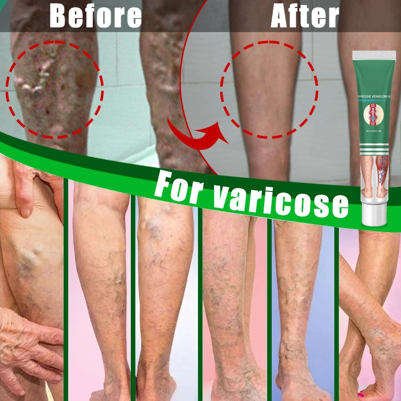 

ointment for varicose veins Effective varicose vein relief cream to relieve vasculitis phlebitis spider pain treatment