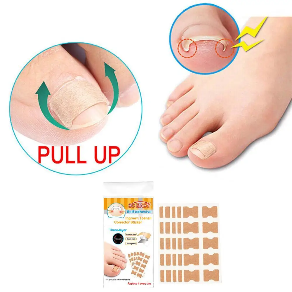 

Nail Nail Correction Stickers Pulling Nails Preventing Recover Squeezing Grooves Corrector Of Electric Treatment Non Tools S9V9