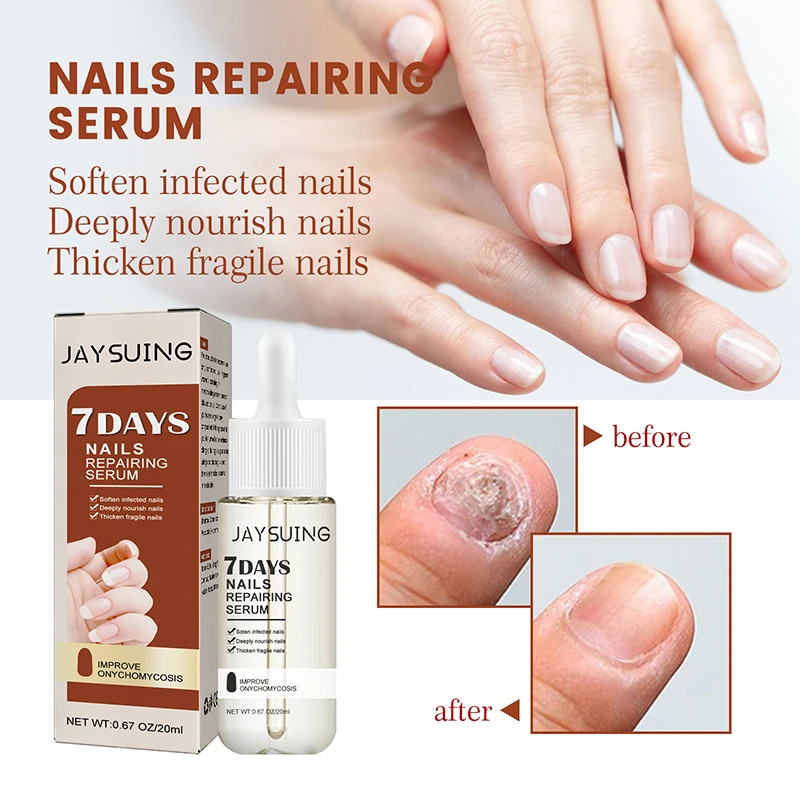 

Sdotter Jaysuing Fungal Nail Treatment Essence Anti Infection Onychomycosis Foot Toe Nail Fungus Removal Toe Care Repair Serum