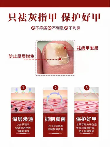 [Watsons Hot Sale] It Is Invalid to Remove 99% Gray Potassium Fungus by Dropping a Drop of Antibacterial and Not Removing Nail!!