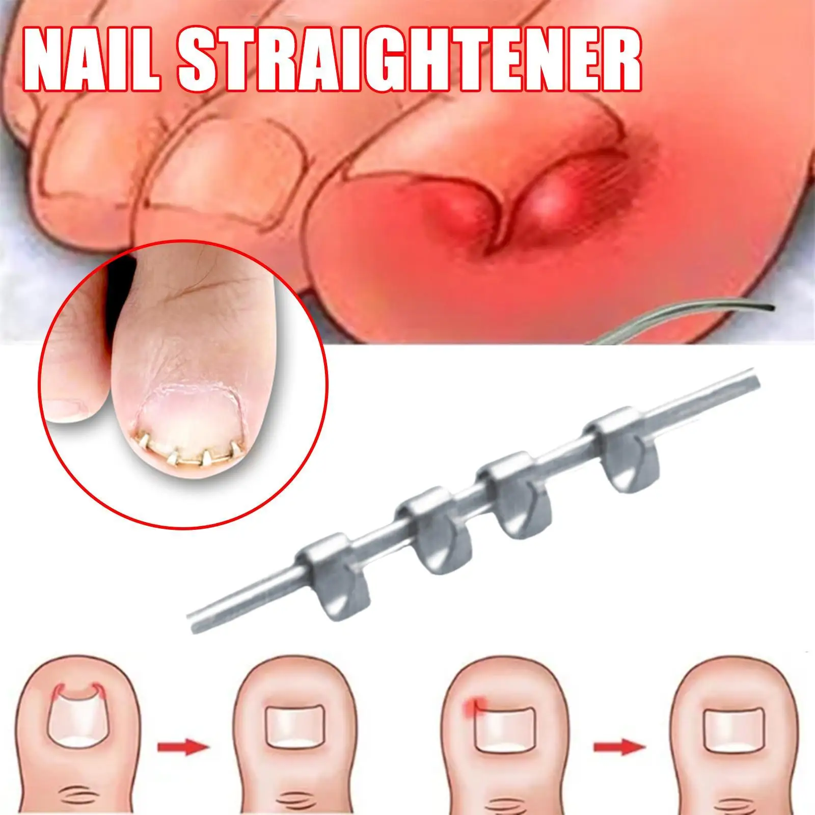 

1Pc Professional Toe Nail Correction Wire Fixer Treatment Tool Pedicure Paronychia Recover Toenails Corrector Reusable