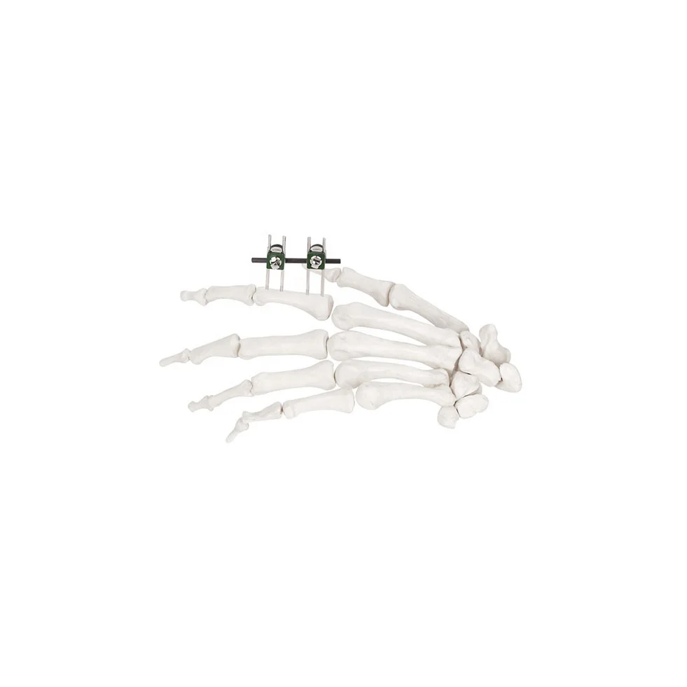 

Orthopedic External Fixation Mini-fixator (Finger &Palm) External Fixators