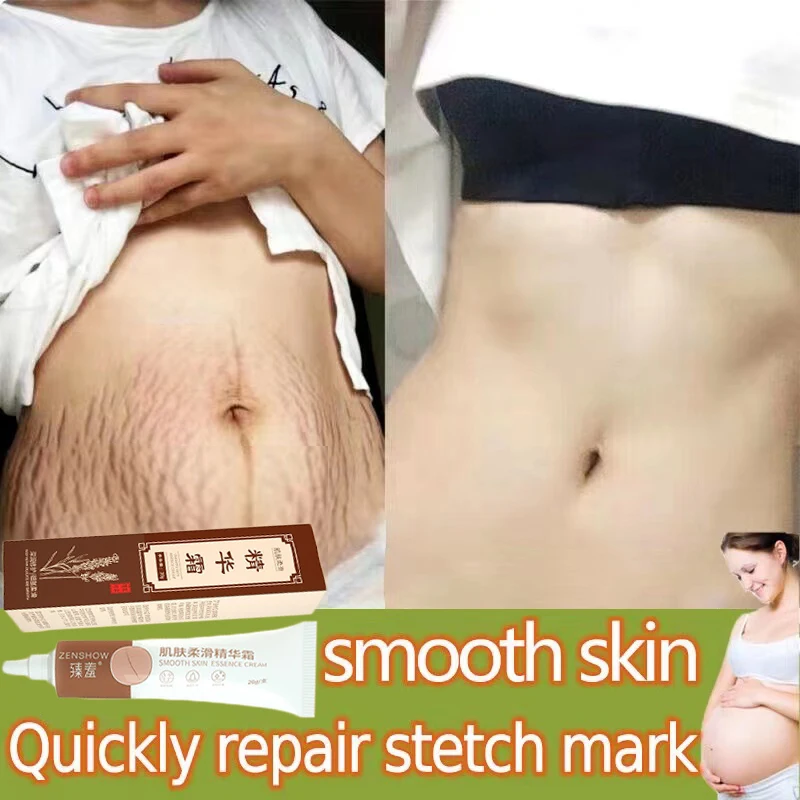 

Removes Stretch Mark Cream To Remove Postpartum Obesity Pregnant Women Repair Scar Anti-Aging Anti-Winkles Firming Body Cream