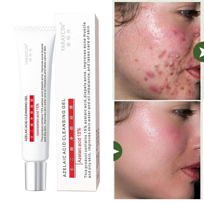 

15% Azelaic Acid Removal Cream Fade Acne Spots Oil Control Anti-Acne Shrink Pores Acne Treatment Cream Face Gel Skin Scar