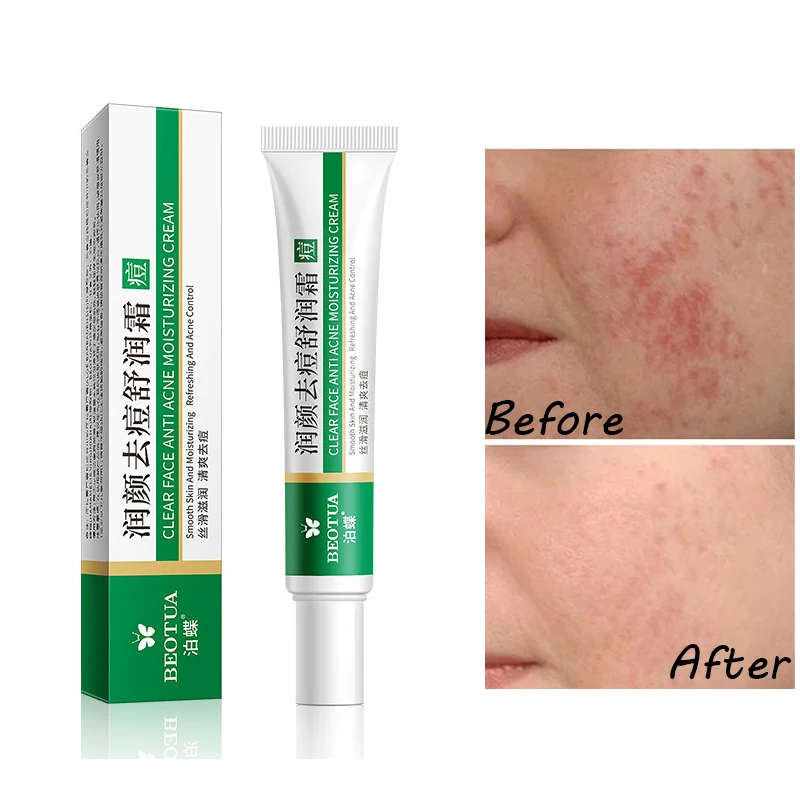 

Effective Acne Removal Cream Herbal Oil Control Spots Scar Remove Cream Whitening Moisturizing Face Gel Skin Care 20g