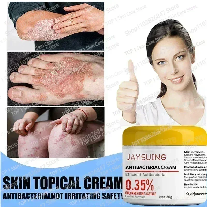 Псориаз Антибактериальный против зуда Дерматити Экзема Крапивница Алергия Кожа