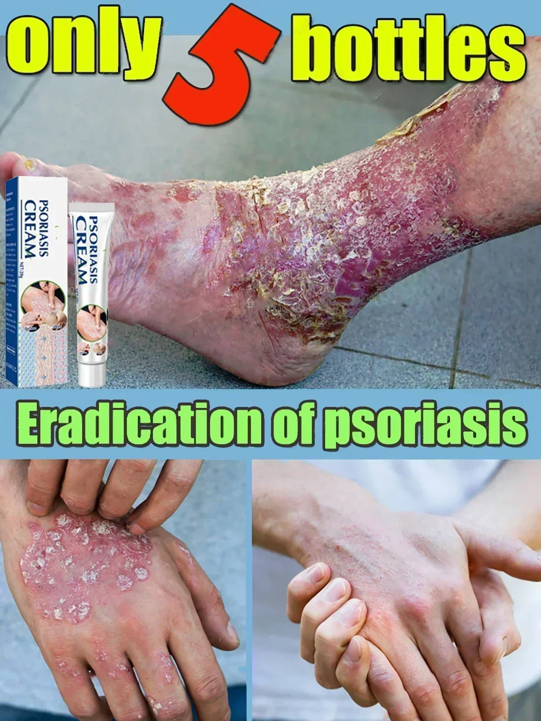 Лучший продукт против дерматита при псориазе и экземе: натуральный растительный