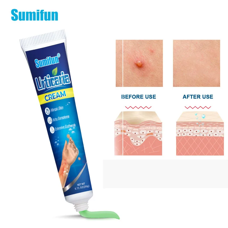 

Лечение крапивницы, 20 г, крем экзема дерматит, псориаз, противозудная мазь, антибактериальный, против зуда, медицинский пластырь