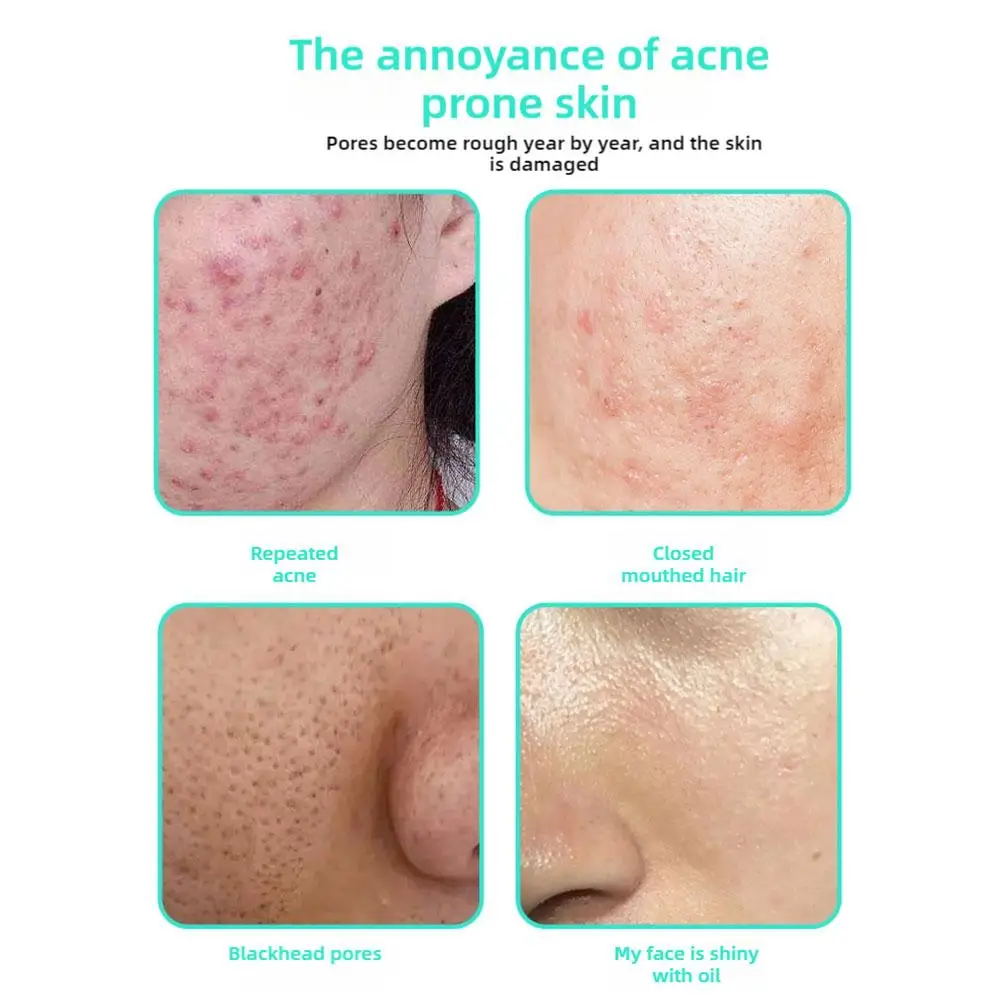 Крем для очистки пор с салициловой кислотой сжимает поры устраняет черные точки