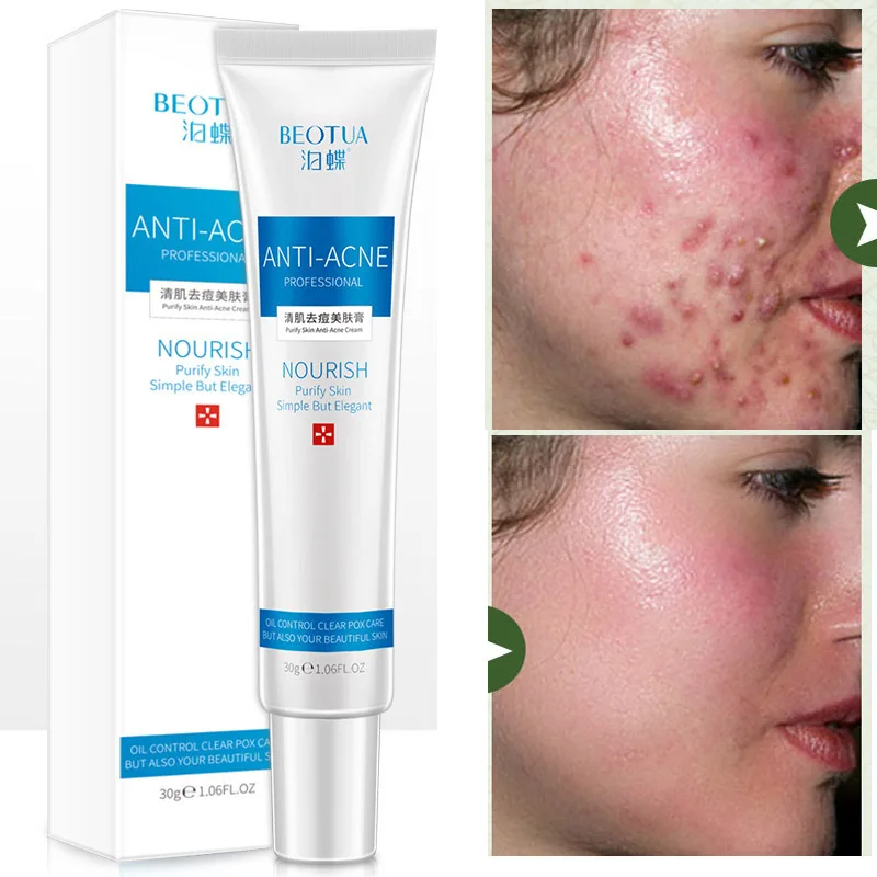 

Anti Acne Cream Acne Scars Removal Face Cream Acne Treatment Oil Control Shrink Pores Moisturizing Fade Pimple Marks Spots 30ml