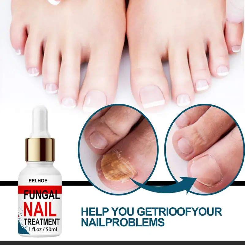 

ELECOOL Nail Fungal Treatment Feet Care Essence Foot Repair Nail Fungus Removal Serum Anti Infection Paronychia Onychomycosis