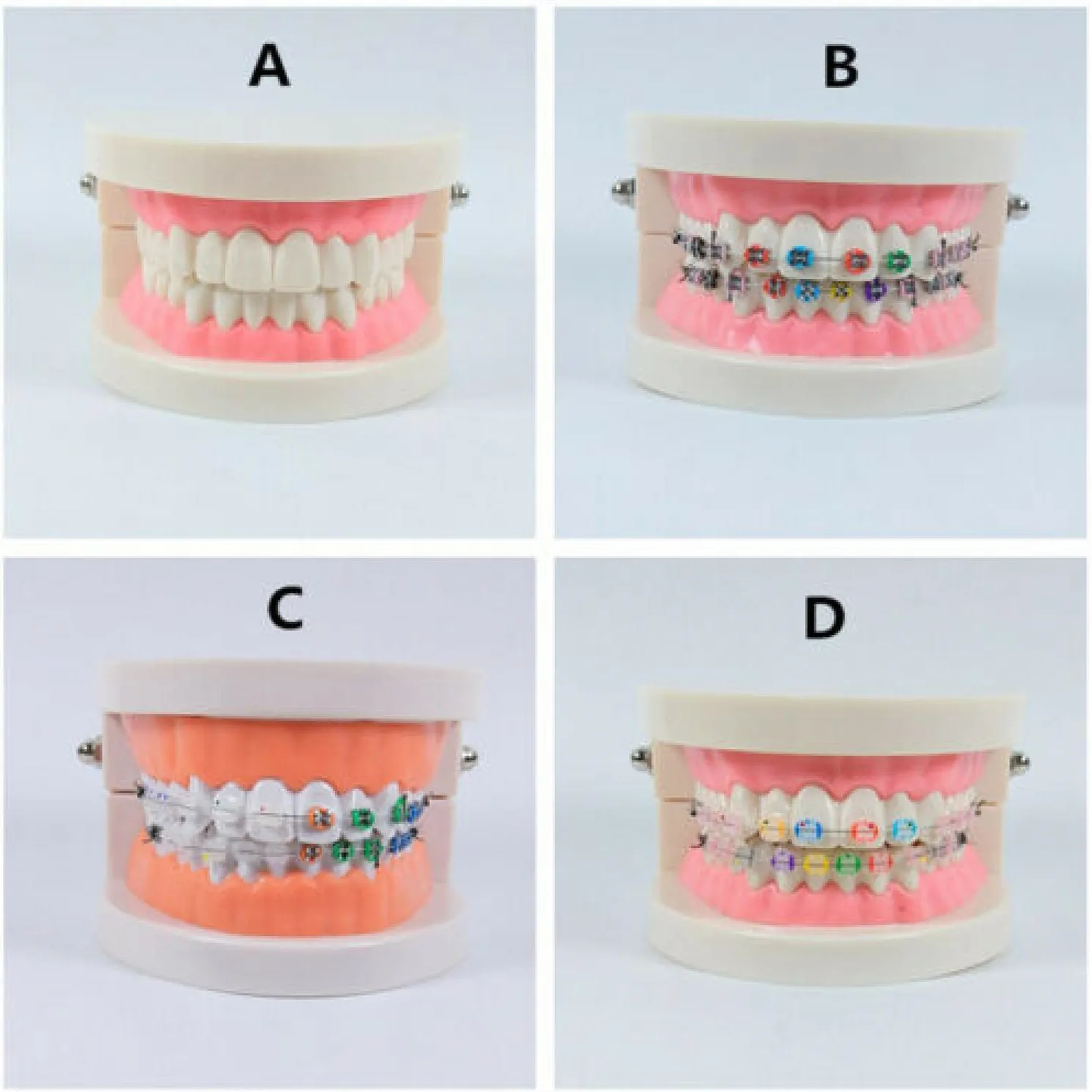 

1 шт., Ортодонтическая модель с керамическим металлическим кронштейном