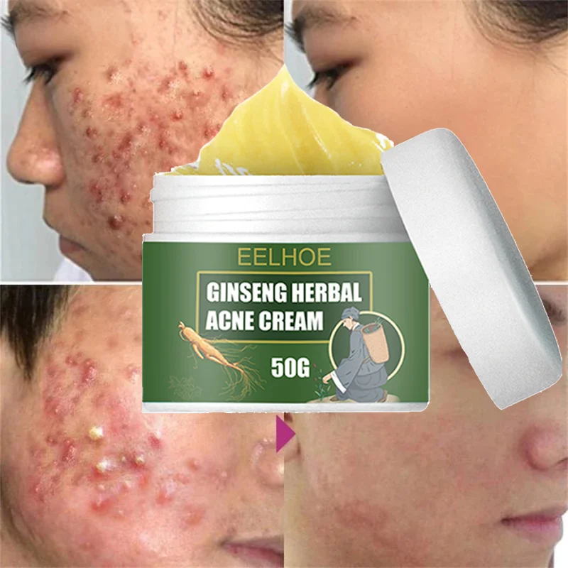 

Ginseng Herb Acne Removal Cream Treatment Pimple Scar Spots Shrink Pores Oil Control Whitening Moisturize Face Acne Skin Care
