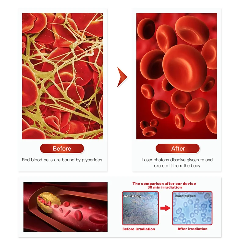 

Wearable laser device for hypertension and other blood symptoms