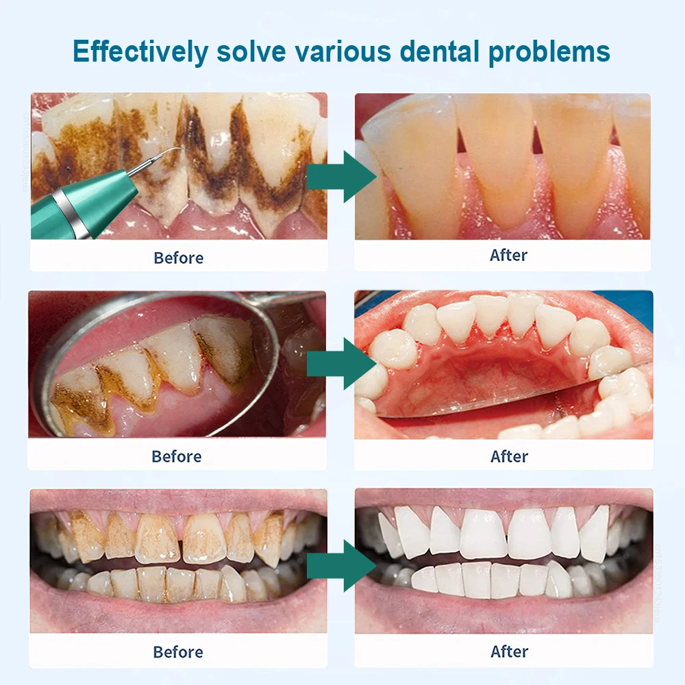 Ультразвуковой очиститель зубов устройство для удаления зубного камня зубной