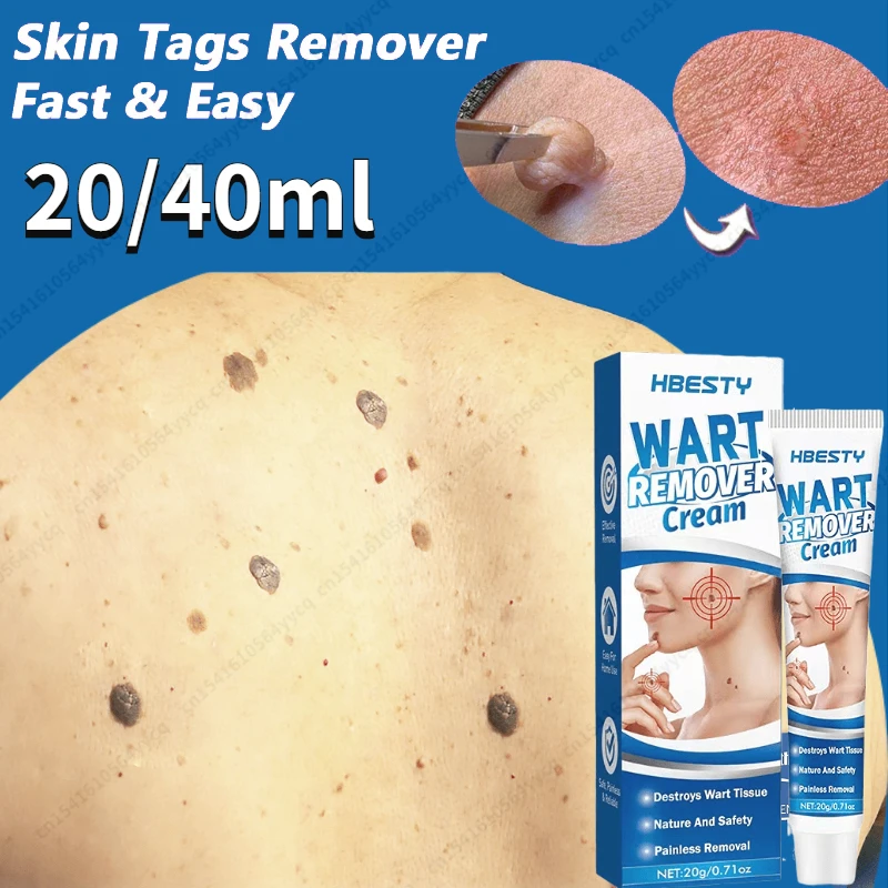 

Warts Remover Skin Tag Remover Cream Painless Mole Skin Dark Spot Serum Freckle Face Wart Tag Treatment Removal Essential Oil